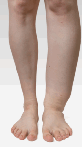 7 Ways to Treat Leg Lymphedema and Reduce Swelling