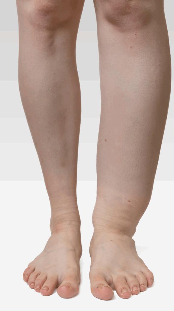 A person’s legs and feet show swelling and puffiness around the right ankle and lower leg, suggesting possible edema that may benefit from leg lymphedema treatment, against a white background.