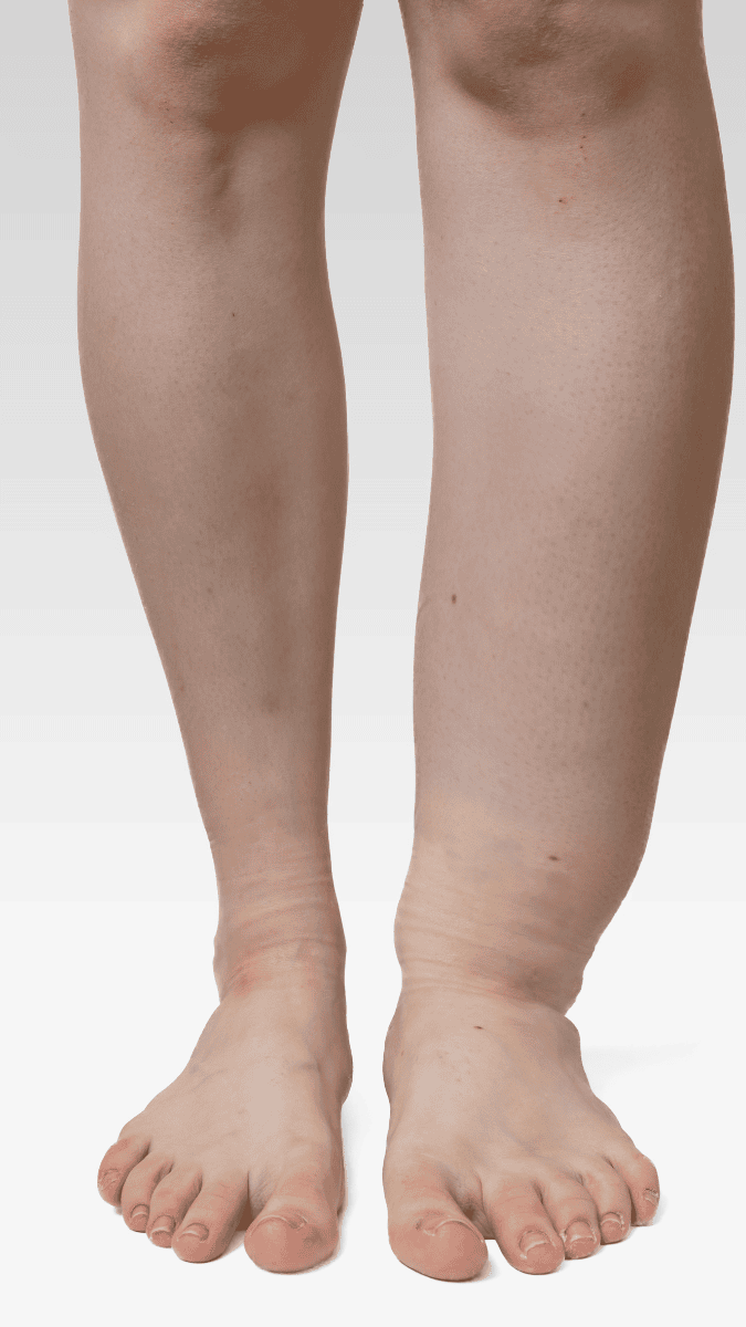 A person’s legs and feet show swelling and puffiness around the right ankle and lower leg, suggesting possible edema that may benefit from leg lymphedema treatment, against a white background.