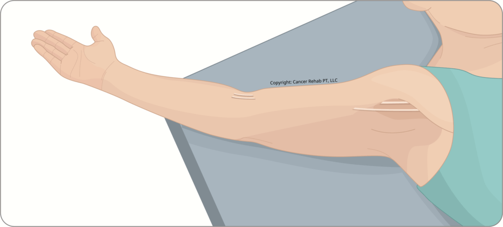 Illustration of a person lying down with an outstretched arm, —highlighting signs of axillary cording or axillary web syndrome. The person is wearing a teal top.