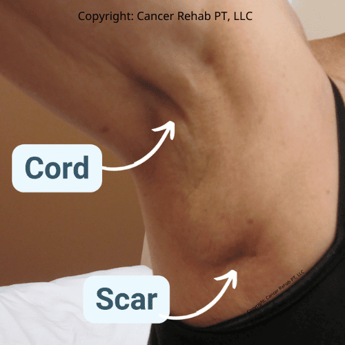 Axillary web syndrome (cording). 