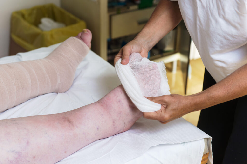 A person is wrapping a bandage around another's swollen, discolored leg and foot—signs of lymphedema. Nearby, the other bandaged leg rests on a bed, surrounded by medical supplies. Learn 10 Tips for Better Living with Lymphedema in the Legs.