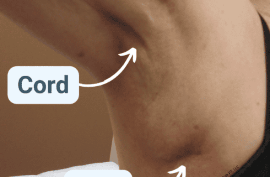 A close-up of an armpit showing a visible cord and a scar, each labeled with arrows pointing to the respective areas. The image is credited to Cancer Rehab PT, LLC.
