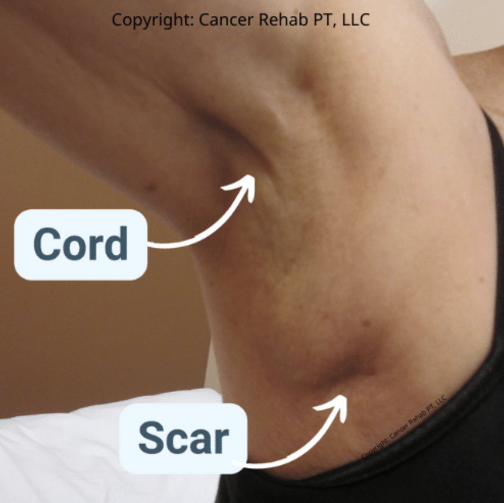 A close-up of an armpit showing a visible cord and a scar, each labeled with arrows pointing to the respective areas. The image is credited to Cancer Rehab PT, LLC.