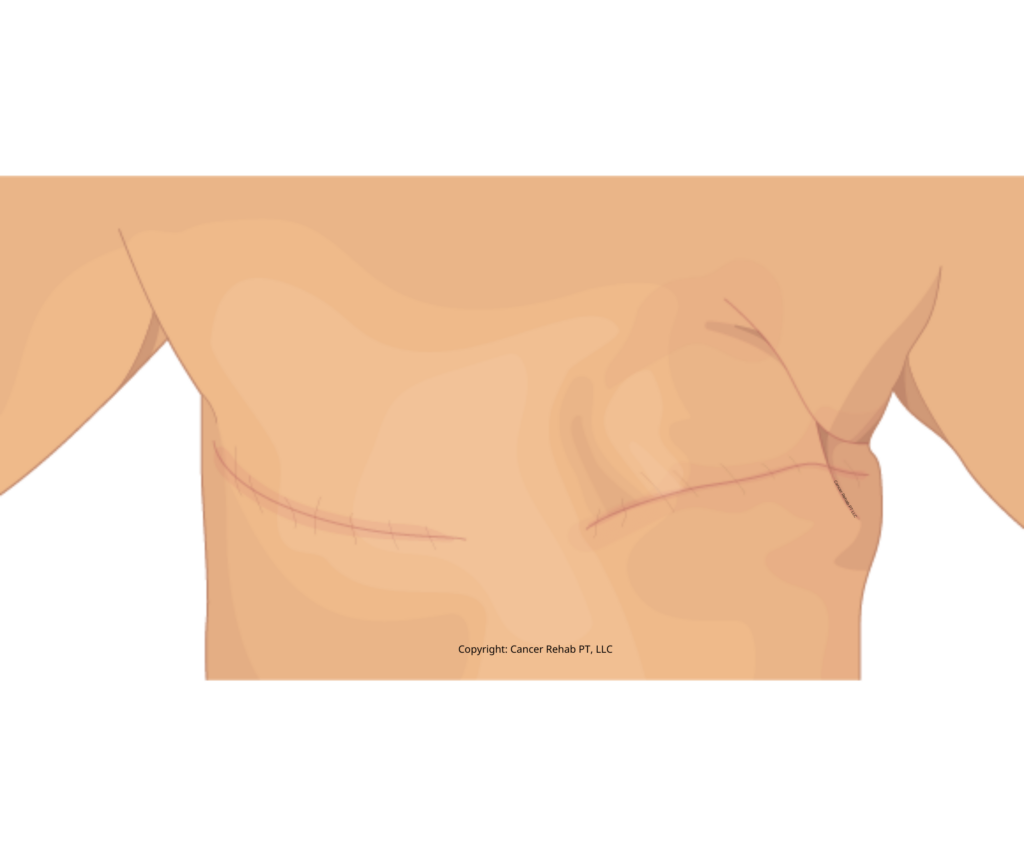 Illustration of a person’s chest showing a horizontal surgical scar and indentation, resembling a mastectomy scar tissue photo. The skin tone is light, with no visible clothing or additional features.