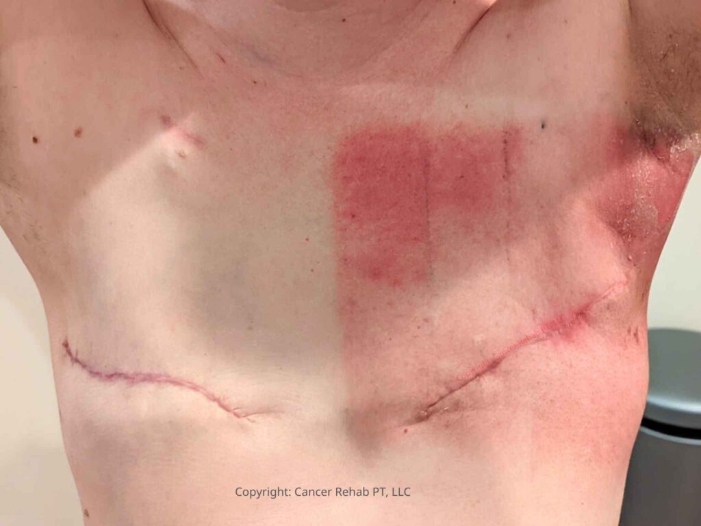 Skin irritation as a side effect of radiation after breast cancer.