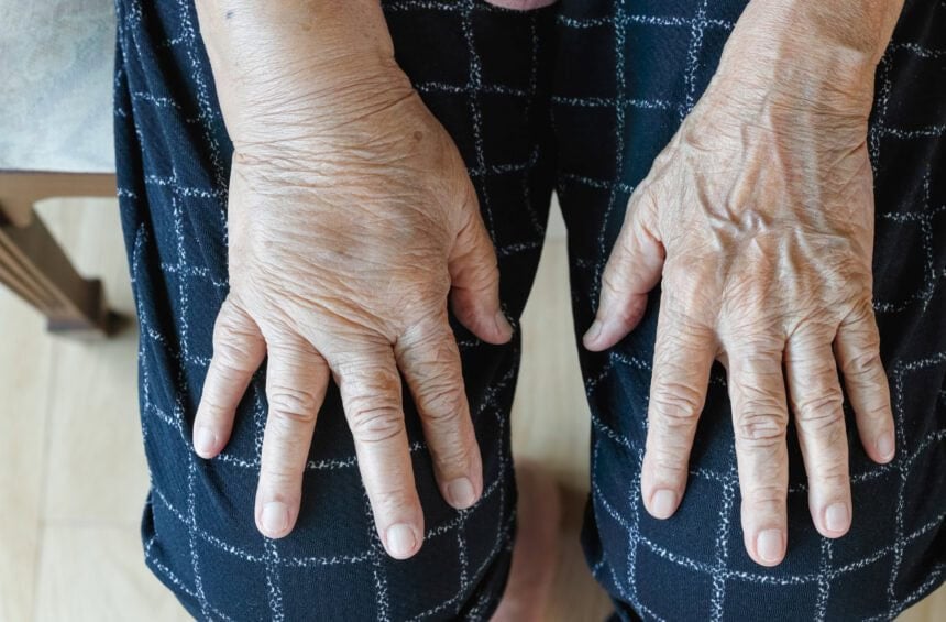 A close-up view of an elderly persons hands, possibly affected by hand lymphedema, resting on their knees, with wrinkled skin and visible veins. The person is wearing dark pants with a white checkered pattern.