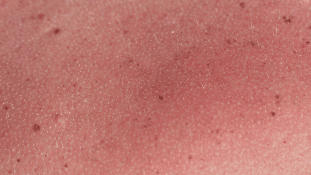 Skin changes as one of the side effects of radiation for breast cancer. Close-up of reddish skin with visible pores, fine hairs, small dark spots, and slight irritation—features that may resemble a mild radiation therapy skin burn or effects seen in a radiation therapy photo.