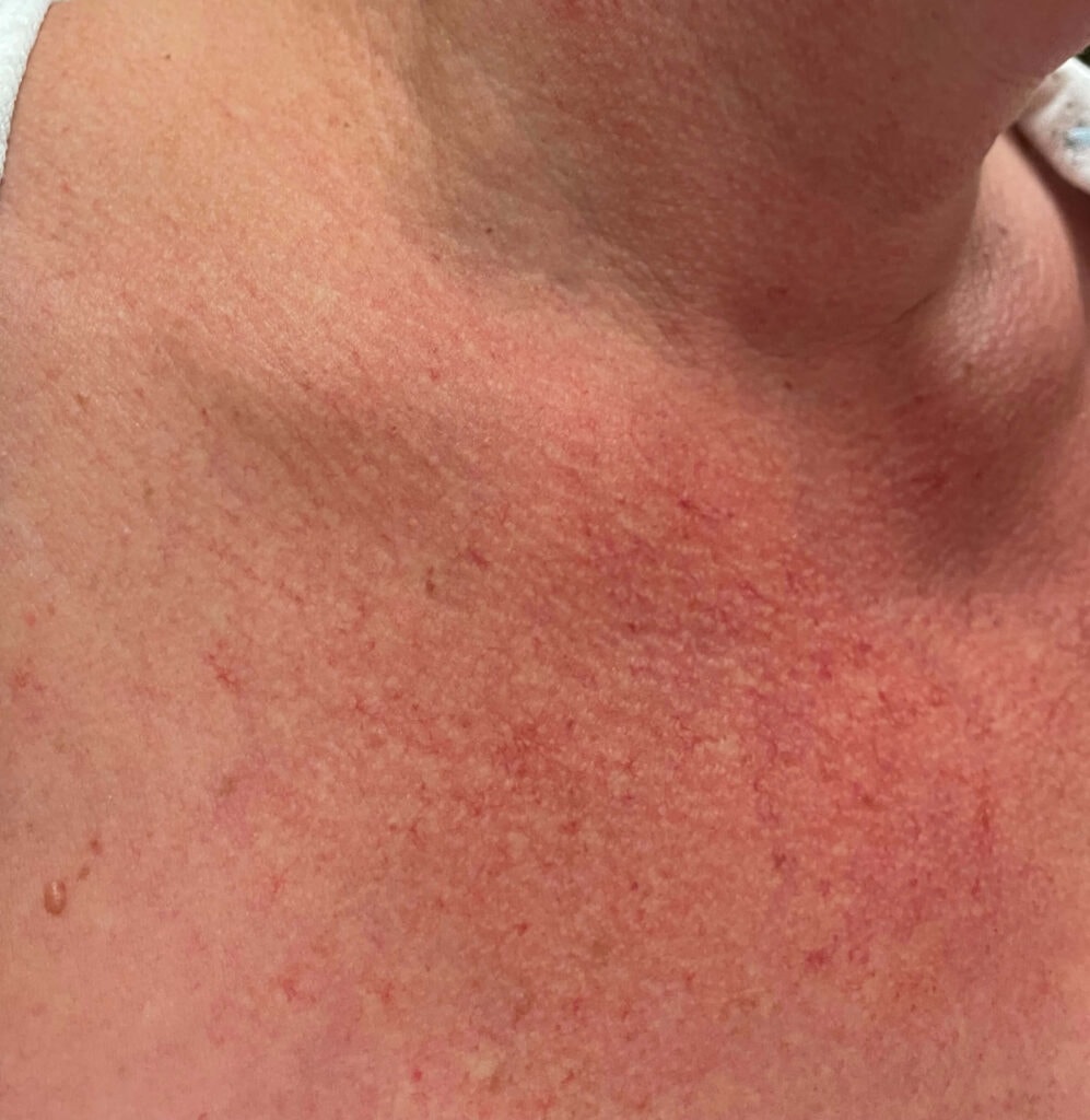 A close-up of a persons neck and upper chest showing red, irritated, and slightly bumpy skin, possibly due to the side effects of radiation therapy after breast cancer