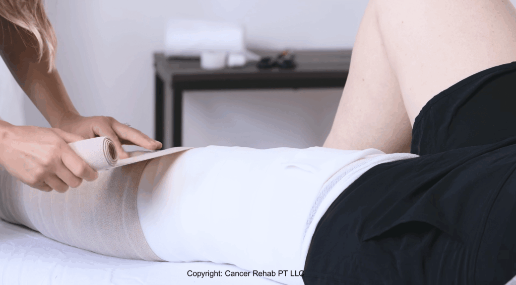 A person wraps a compression bandage around another’s thigh as they lie on a bed, suggesting leg lymphedema treatment