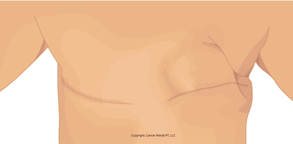 Illustration of a person’s chest with visible mastectomy scars—one side flat, marked by a horizontal surgical line—to highlight the journey of breast cancer.