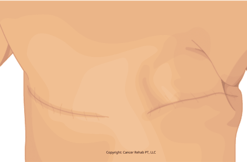 Illustration of a person’s chest with visible mastectomy scars—one side flat, marked by a horizontal surgical line—to highlight the journey of breast cancer.