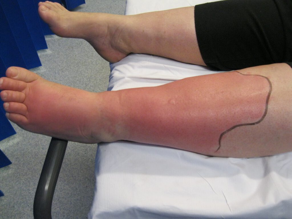 A person with cellulitis lies on a hospital bed, their swollen, red lower leg marked by a black outline. The redness extends from the foot to below the knee, possibly complicated by underlying lymphedema.