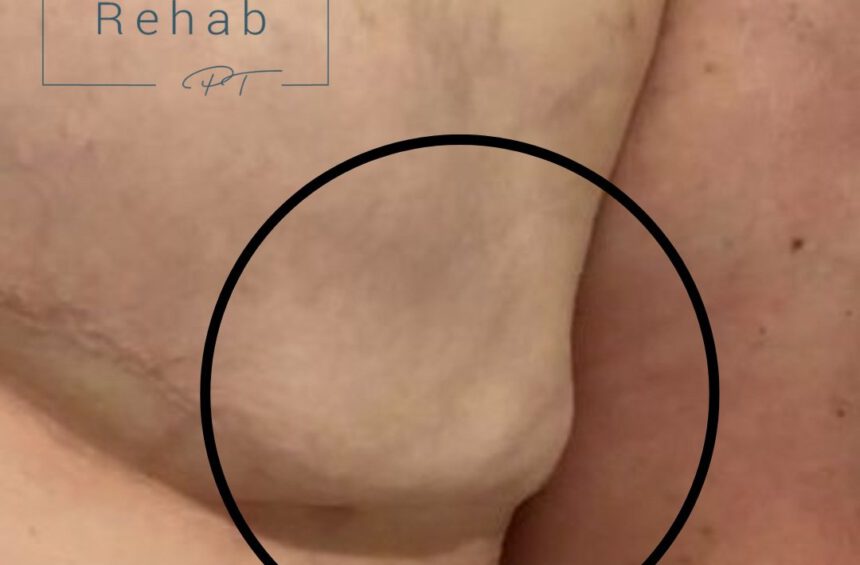 Close-up of a person’s armpit with visible swelling or abnormal contour, possibly indicating seroma after surgery, circled in black. Cancer Rehab PT logo is in the upper left corner. Copyright: Cancer Rehab PT LLC.