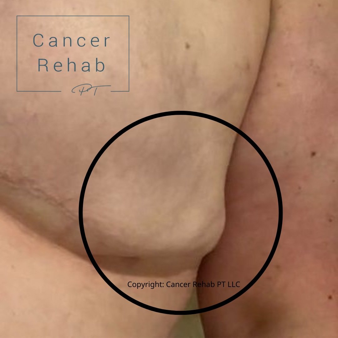 Seroma After Surgery: What It Is & What to Do