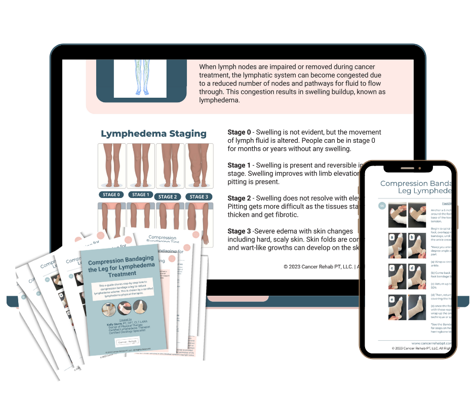 A laptop, smartphone, and printed pamphlets display educational materials about lymphedema staging and compression bandaging. Diagrams, leg photos, and step-by-step instructions are visible on all devices and papers.
