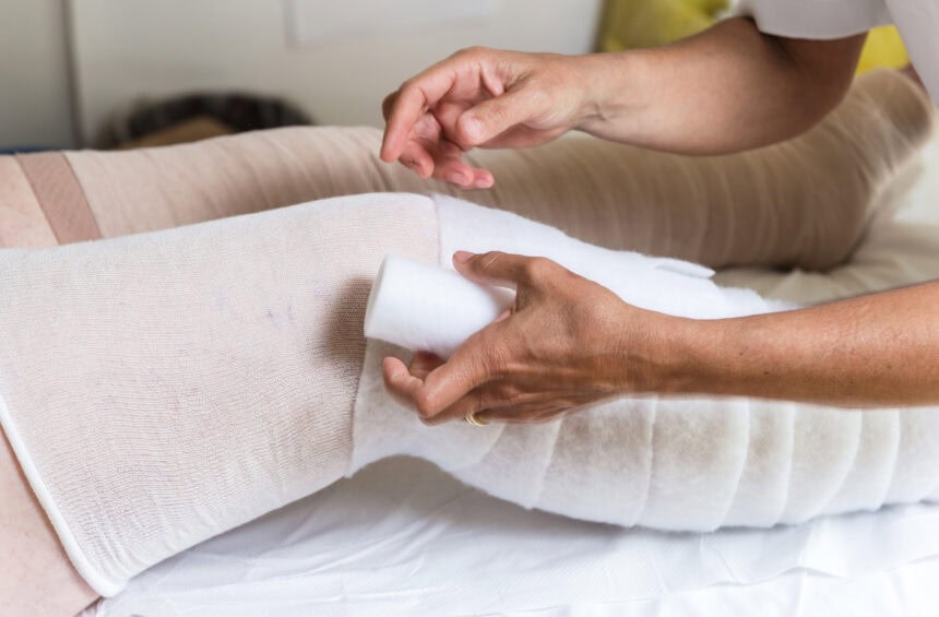 A person is wrapping a large bandage around another persons leg, which is lying flat on a bed, demonstrating lymphedema patient education with proper white padding and bandages already in place.