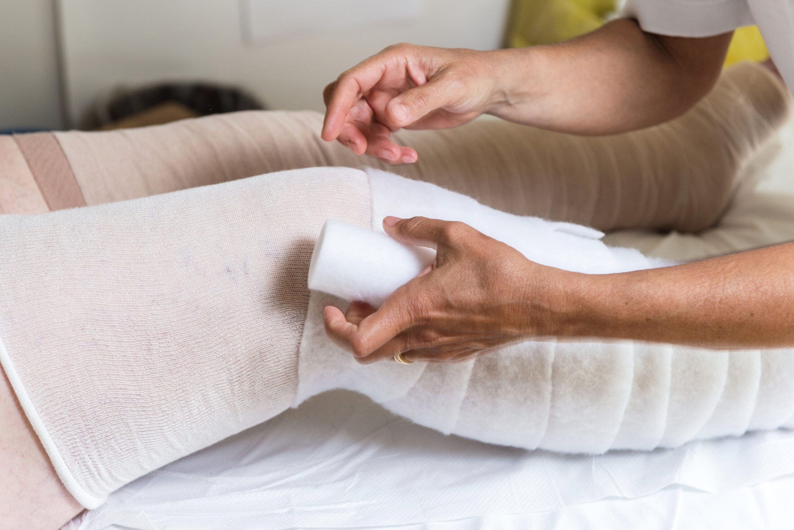A person is wrapping a large bandage around another persons leg, which is lying flat on a bed, demonstrating lymphedema patient education with proper white padding and bandages already in place.