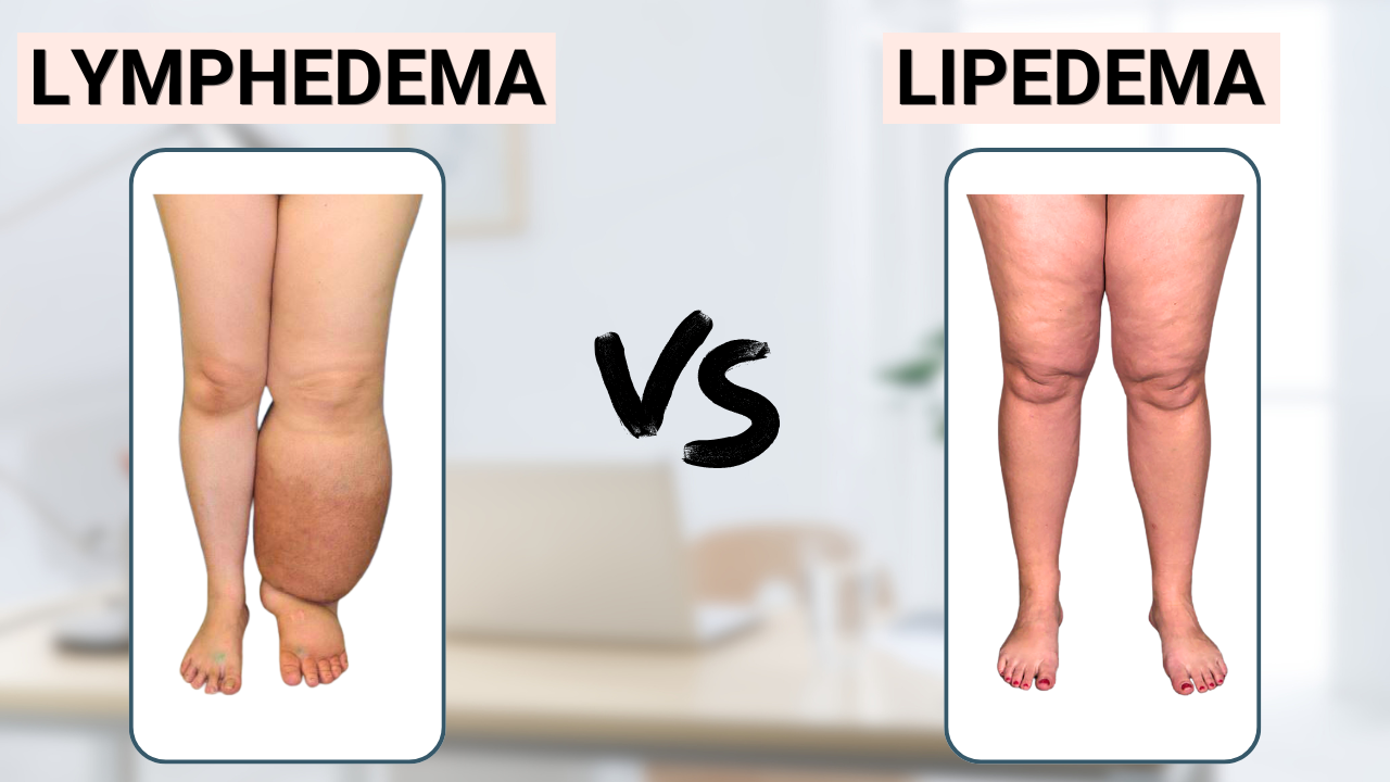 Lipedema vs Lymphedema: What’s the Difference & What to Do