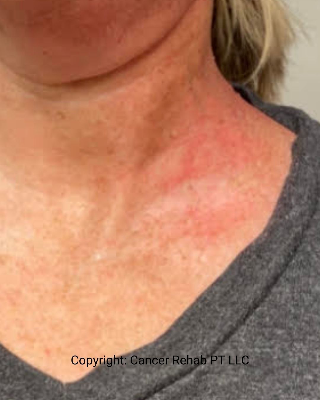 A close-up of a person’s upper chest and neck shows red, irritated skin, a common side effect of radiation therapy. The person is wearing a gray shirt, and the image has a copyright notice from Cancer Rehab PT LLC.