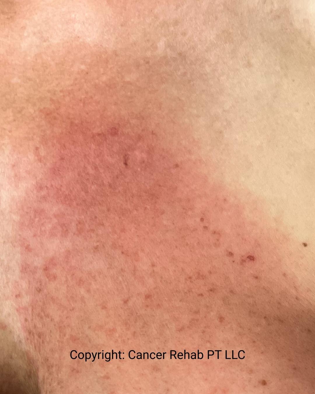 Close-up of skin showing redness and irritation with small red spots, possibly side effects of radiation therapy or a rash. Text at the bottom reads, Copyright: Cancer Rehab PT LLC.