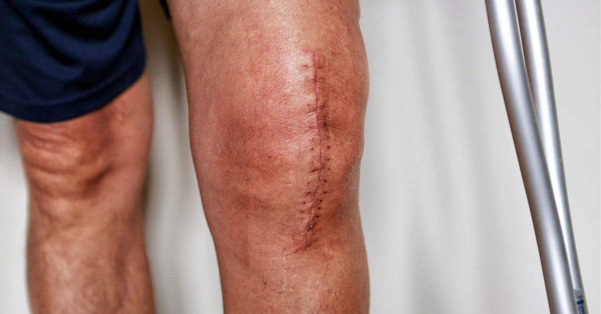 A close-up of a persons knee with a vertical surgical scar, stitches, and visible swelling after surgery. The person is standing, partially supported by crutches.