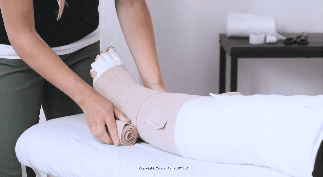 What kind of doctor treats lymphedema? Typically, a lymphedema therapist. The therapist in this image wraps a bandage around another person’s foot and lower leg, which is resting on a treatment table. Medical supplies are visible in the background.