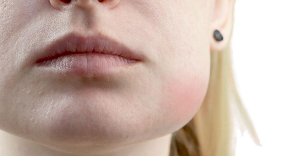 Close-up of a person’s lower face with visibly swollen right cheek, suggesting inflammation or infection. The skin appears slightly red and irritated on the swollen side. The person has light skin and blonde hair.