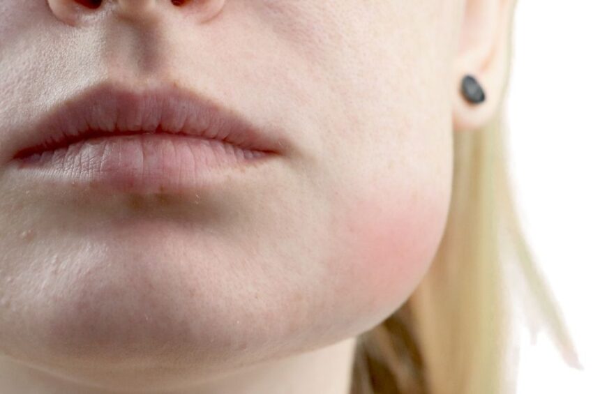 Close-up of a person’s lower face with visibly swollen right cheek, suggesting inflammation or infection. The skin appears slightly red and irritated on the swollen side. The person has light skin and blonde hair.