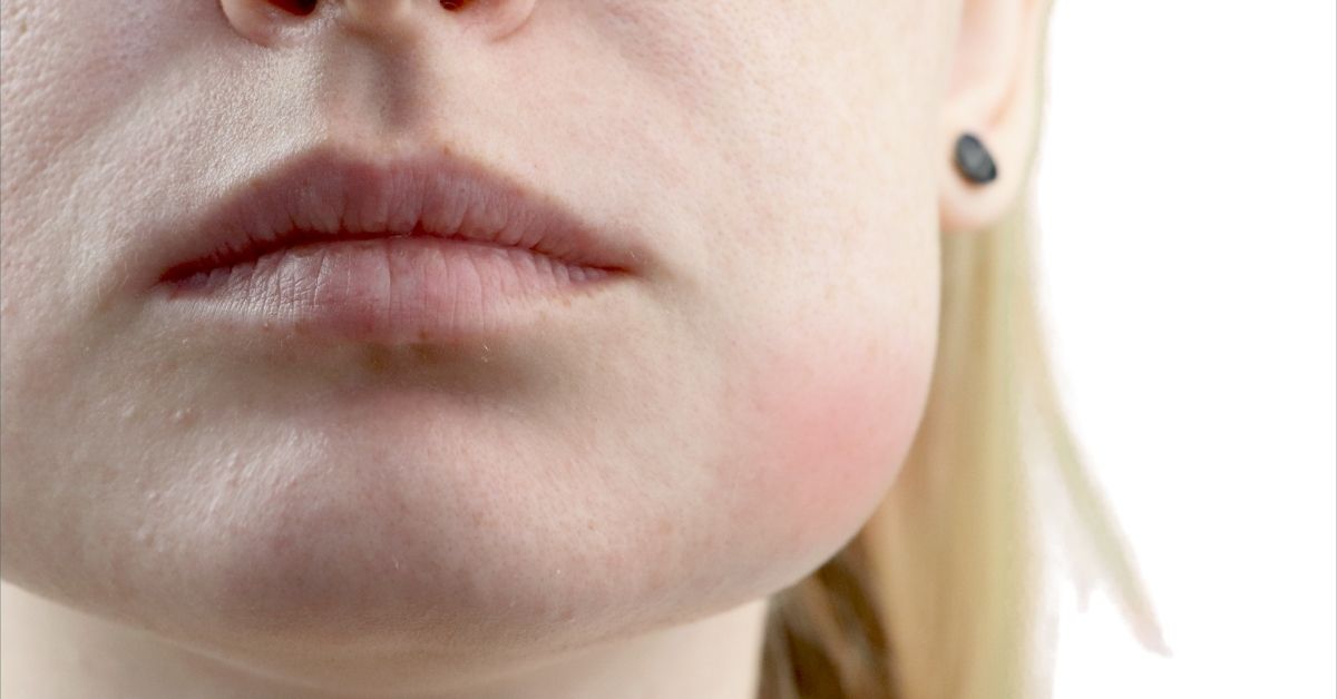 How to Reduce Swelling on Your Face (Lymph Specialist Guide)