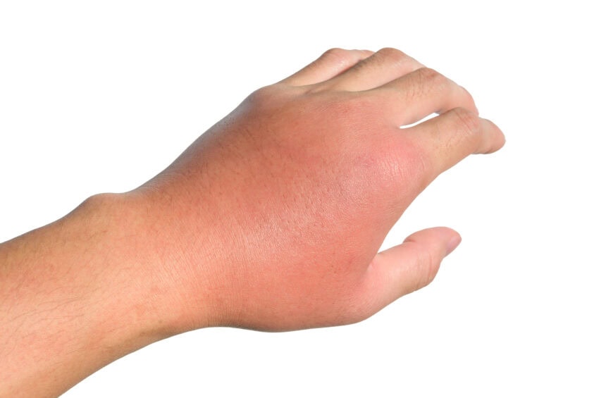 Cellulitis infection in hand.