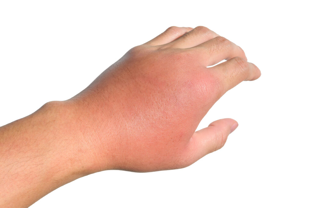 What beginning of cellulitis infection looks like in hand.