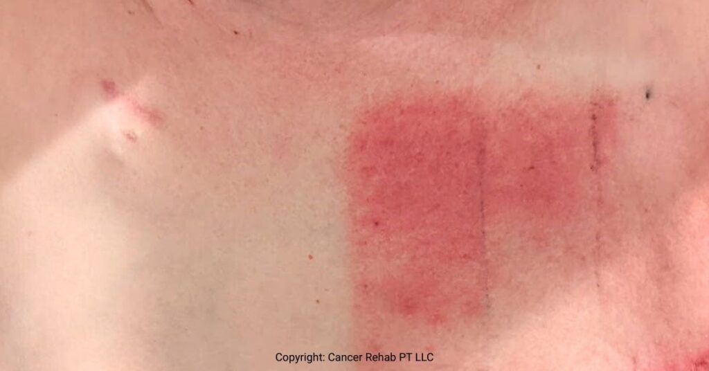 Side effects of radiation therapy on skin.