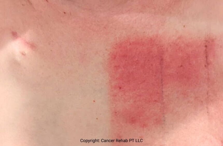 Side effects of radiation therapy on skin.