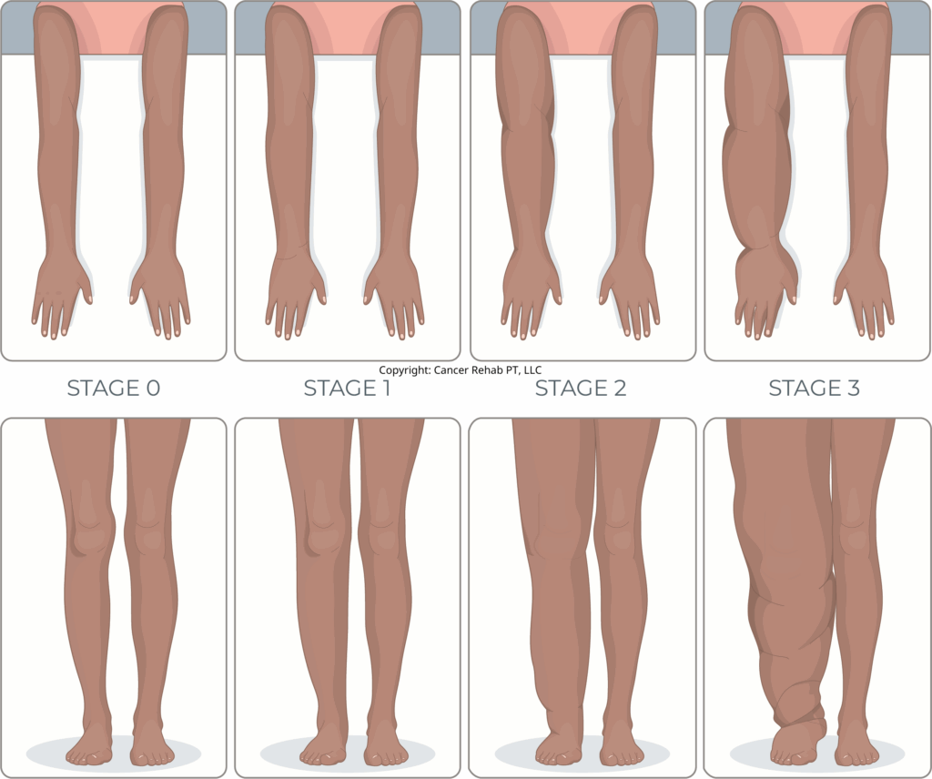 Stages of lymphedema. Lymphedema life expectancy is normal, but you may develop complications with stage 3 lymphedema.