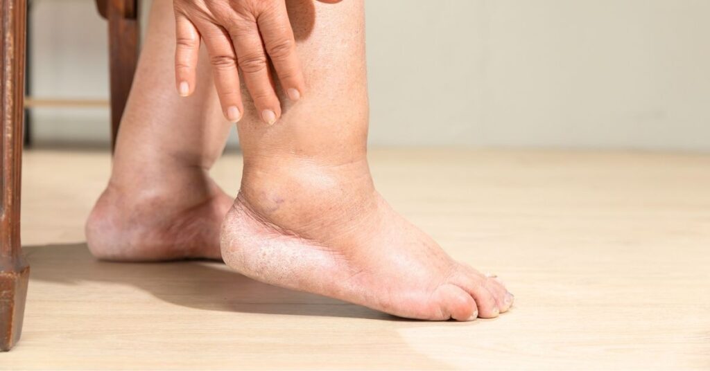 Lymphedema in the leg, swelling.
