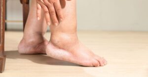 What Kind of Doctor Treats Lymphedema?