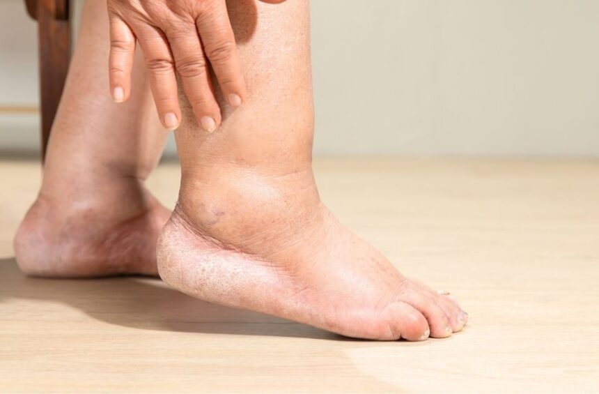 Lymphedema in the leg, swelling.