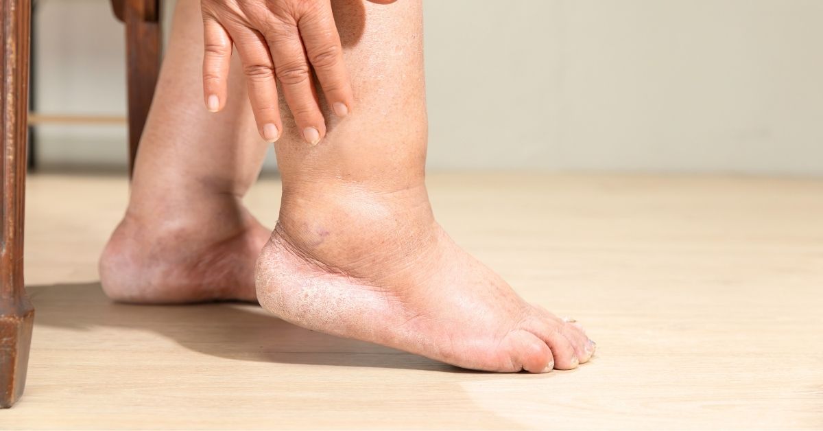 What Kind of Doctor Treats Lymphedema?
