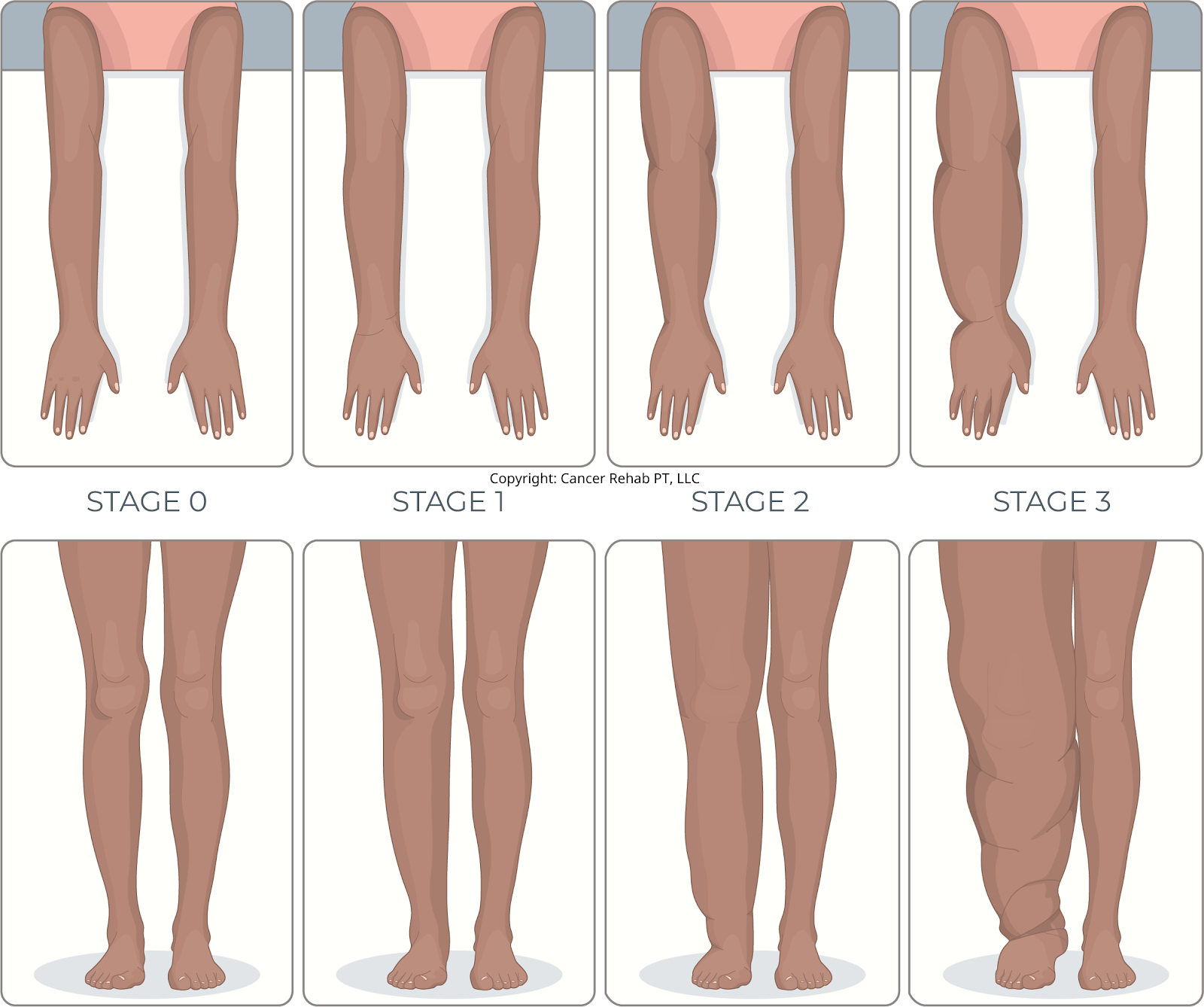 A graphic illustrating lymphedema stages.
