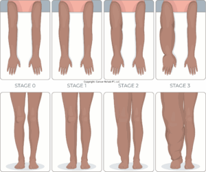 Lymphedema Stages: How to Manage Swelling From 0 to 3