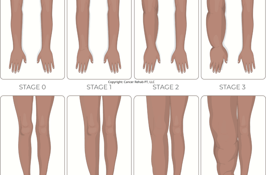 Lymphedema stages from 0 to 3.