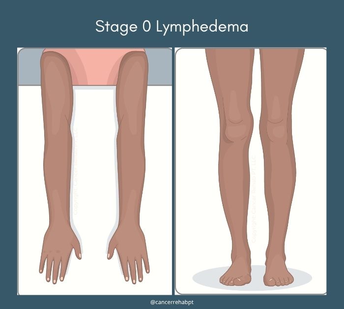 Lymphedema stage 0.