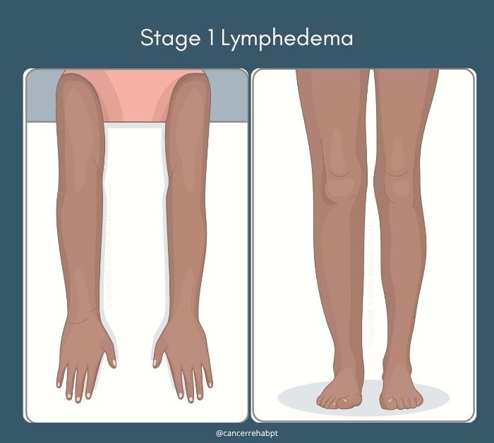 Lymphedema stage 1.