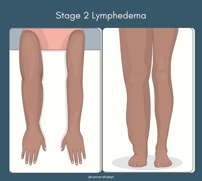 Lymphedema stage 2.