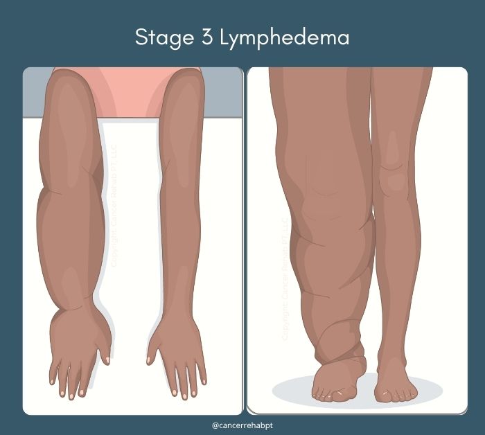 Lymphedema stage 3.