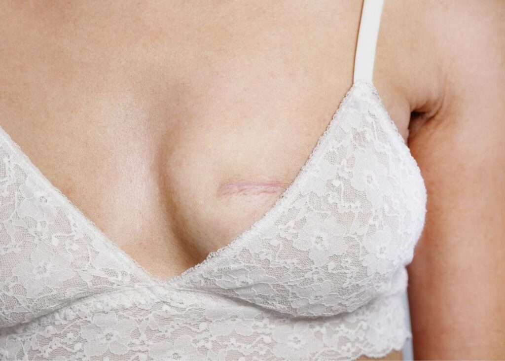 A visual of mastectomy scar.