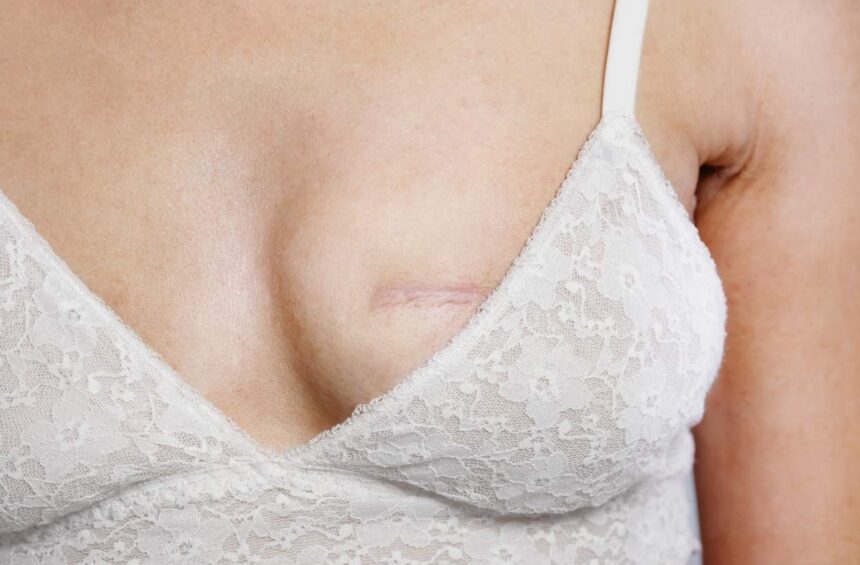 A visual of mastectomy scar.