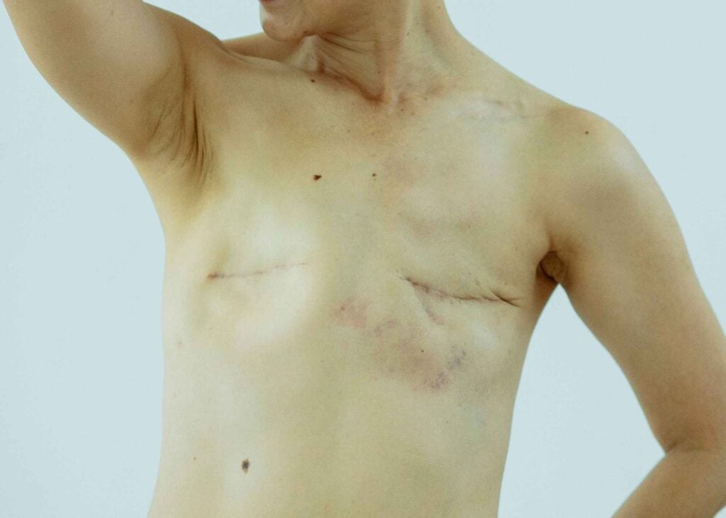 A woman with a large scar on her chest. Mastectomy without reconstruction.