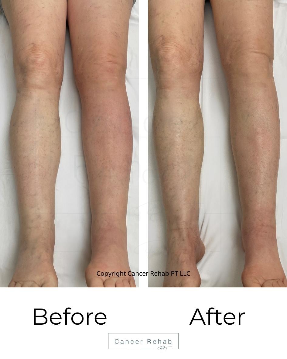 Before and after lymphatic drainage massage for leg lymphedema. 